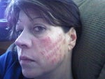 Burns on face after laser hair removal