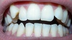 Crowded teeth okay for Invisalign?