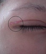 Thick and red scar after eyelid surgery