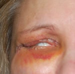 Can't shut eyes after upper and lower blepharoplasty