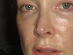 Juvederm in the tear trough area left puffy green ridge
