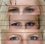 Botox to correct eyebrow ptosis?
