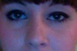 Could asymmetry be resolved with Blepharoplasty?
