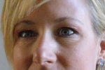 Follow-up on droopy lids after blepharoplasty - will fat pad removal help?