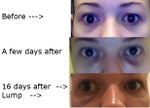 After Juvederm in tear troughs - is it swollen or too much filler?
