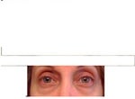 Which procedure is best for eye bags and dark circles?