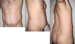 What is the best fat removal technique for me?