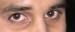 Would a fat graft help under my eyes? How safe is it?