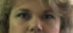 Eyebrow or eyelid surgery for droopy eyes?