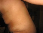 Loose skin after tummy tuck