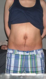 Will thermage work for stomach after 3 children?