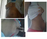 Tummy tuck for diastasis recti? 