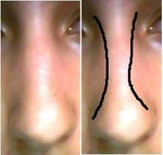 How to straighten my crooked nose?