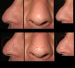 Steroid injections to reduce lymphatic edema on nose?