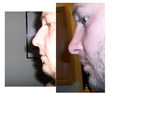 Reduced breathing after rhinoplasty