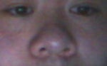 Fix flat, bulbuous Asian nose