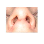 Can uneven swelling affect nostril shape/width?