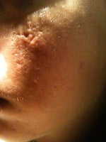 Worse scarring after excision and laser treatments