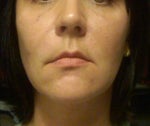 Swelling from radiesse?