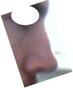 Nasal implant revision