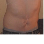 Any way of reducing scar tissue on stomach from an old operation?