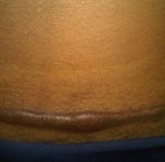 Would I be able to get rid of this scar?