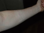 Getting rid of arm scars from self harm