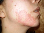 Will chemical-peel burn end up as a scar?