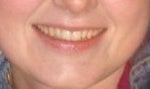 Would Invisalign Express work to correct only one crooked tooth?