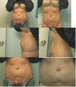 Full or mini tummy tuck needed to get flat stomach again?