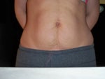Mini-tummy tuck candidate?