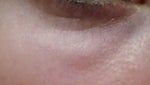 Fat lumps after transfer to the lower eyelid