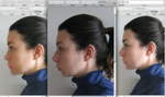 Surgery after Artefill?