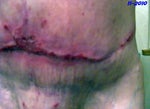 This was taken the last day of November 2010.  I had been having alot of abdomen congestion you can tell by the discoloration on my skin and all the blood vessels sticking up.  I was swollen.