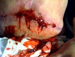 Typical response from my incision when I try to do normal daily movements.. Stretching, trying to bend etc.. 02/24/11