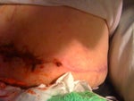 As you can see it randomly opens and bleeds rather quickly altho I do not take any blood thinners at all.