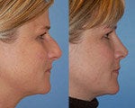 Rhinoplasty before and after photos