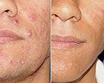 Acne Treatment before and after photos