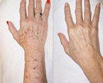 Age Spots Treatment before and after photos