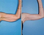 Arm Lift before and after photos
