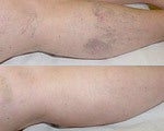 Sclerotherapy before and after photos