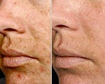 Melasma Treatment before and after photos
