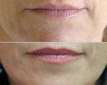 Silicone Injections before and after photos