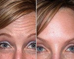 Botox before and after photos