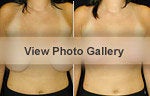 Breast Lift before and after photos
