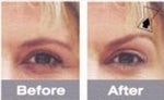Test-drive a Brow Lift at home