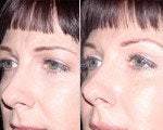 Brow Lift before and after photos