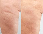 Cellulite Treatment before and after photos