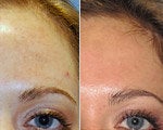 Chemical Peel before and after photos