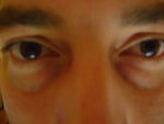 30 year old male tear trough
